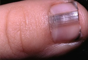 nail melanoma 300x203 Black Streaks Under the Nails